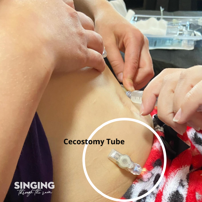 Cecostomy: What it is, The different Types, & How it Works